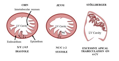 lv non compaction criteria